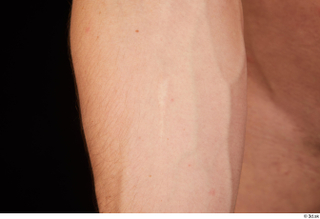 Max Dior arm scar 0001.jpg